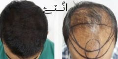 زراعة الشعر في الرياض